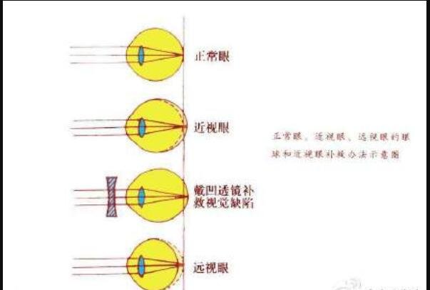 中国近视患者人数多达6亿，近视和远视可以相互抵消吗，近视眼如何改善